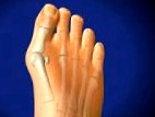 Современные методы исцеления Hallux valgus  