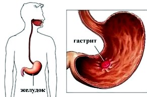 Главные симптомы гастрита 