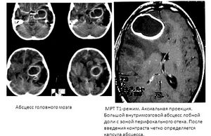 Абсцесс мозга: предпосылки и исцеление 