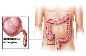 Аппендицит: симптомы, предпосылки, исцеление 