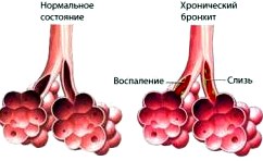 Обретенный бронхит: исцеление и профилактика 