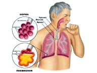 Сущность и методика исцеления пневмонии 