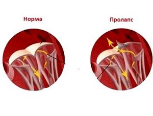 Вчені оприлюднили нові факти про пролапс  