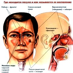 Синусит: как его избежать и вылечить 