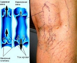 Варикоз отступает: новая методика исцеления 