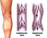 Варикоз - симптомы и профилактика. Исцеление варикоза без операций. 